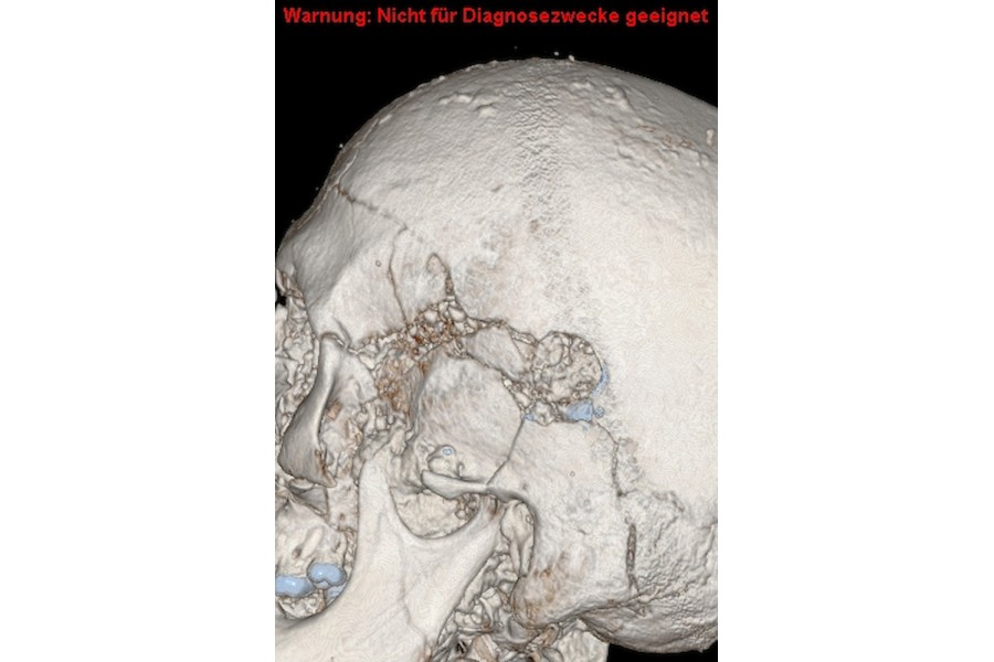 Auf den CT-Bildern sieht man den Schädel in einer 3D-Rekonstruktion. Je nach der Röntgendichte können Materialen unterschiedlich dargestellt werden. Das sieht man sehr gut an den Zähnen: Zahnschmelz ist das härteste Material in unserem Körper, hier sind die Zähne blau eingefärbt. In der Mitte des Schädels sieht man das Einschussloch – auch hier sind noch blaue Stellen zu sehen. Das sind Rückstände der Bleikugel.